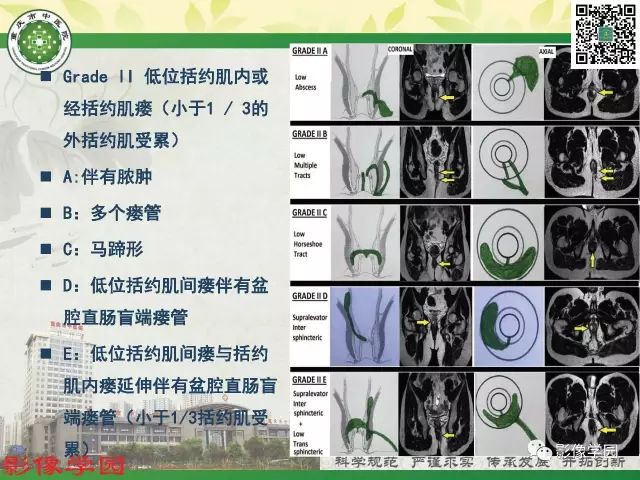 【PPT】复杂性肛瘘的MRI诊断