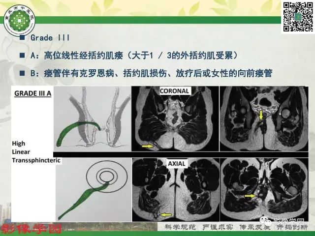 【PPT】复杂性肛瘘的MRI诊断