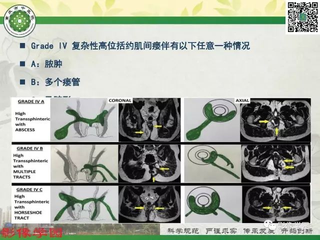 【PPT】复杂性肛瘘的MRI诊断
