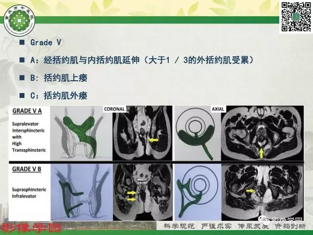 【PPT】复杂性肛瘘的MRI诊断