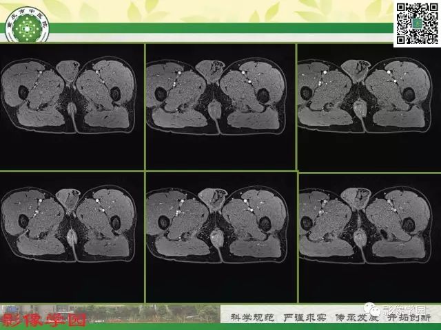【PPT】复杂性肛瘘的MRI诊断