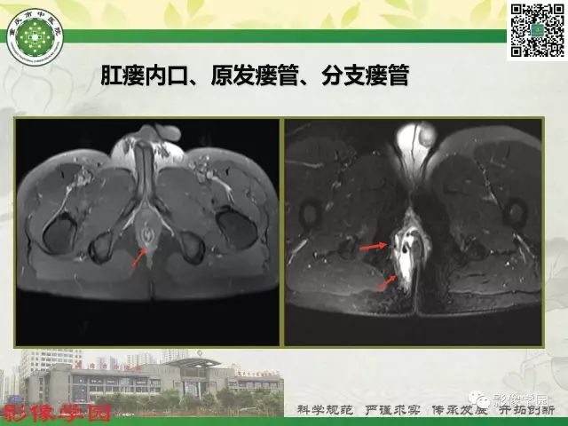 【PPT】复杂性肛瘘的MRI诊断