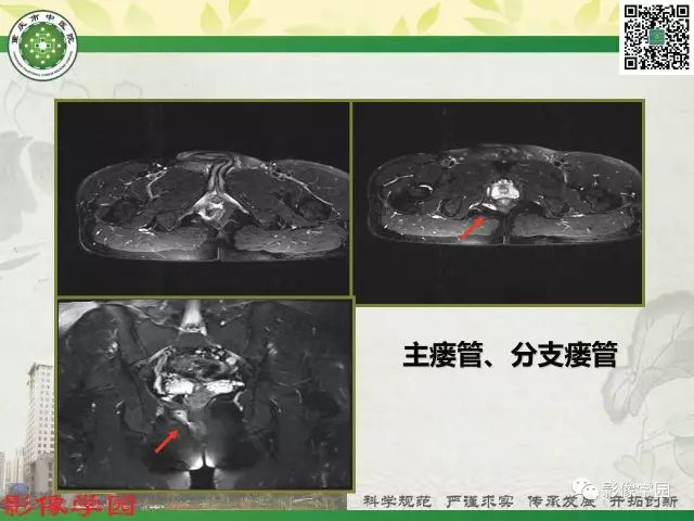 【PPT】复杂性肛瘘的MRI诊断