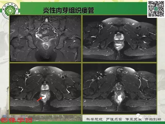 【PPT】复杂性肛瘘的MRI诊断