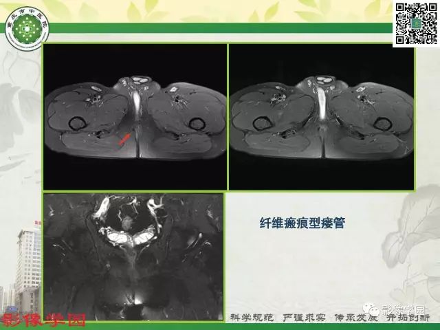 【PPT】复杂性肛瘘的MRI诊断