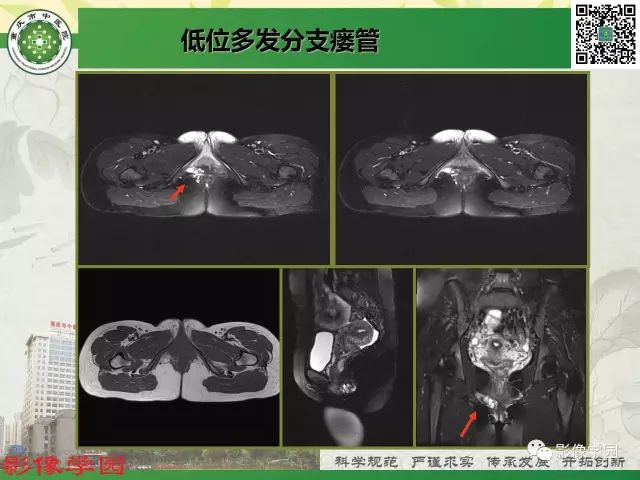 【PPT】复杂性肛瘘的MRI诊断