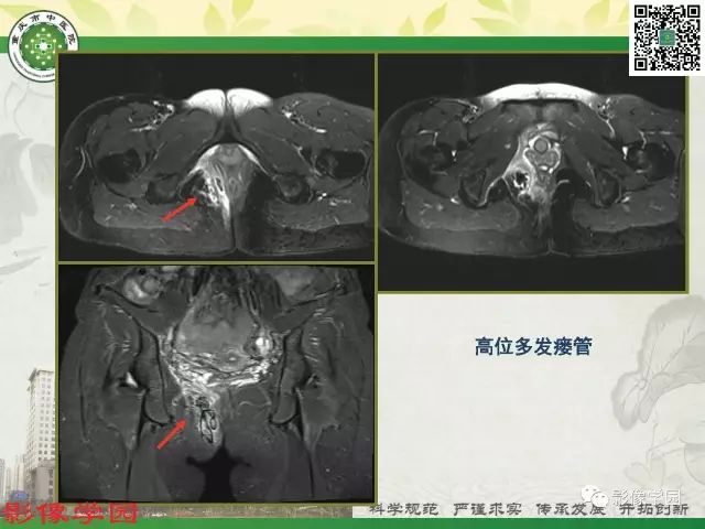 【PPT】复杂性肛瘘的MRI诊断