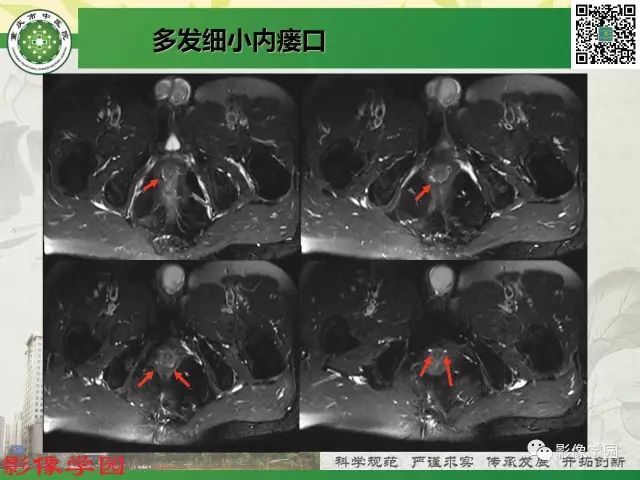 【PPT】复杂性肛瘘的MRI诊断