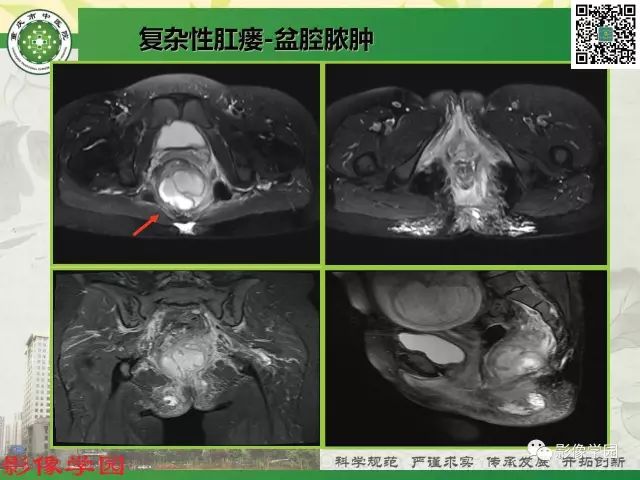 【PPT】复杂性肛瘘的MRI诊断