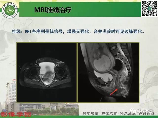 【PPT】复杂性肛瘘的MRI诊断