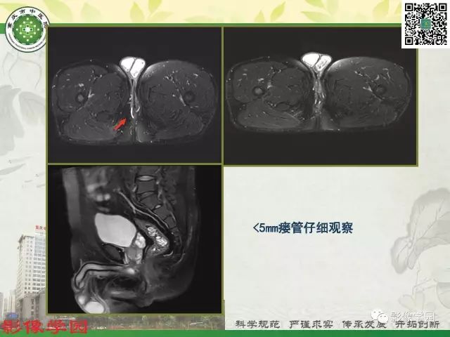【PPT】复杂性肛瘘的MRI诊断