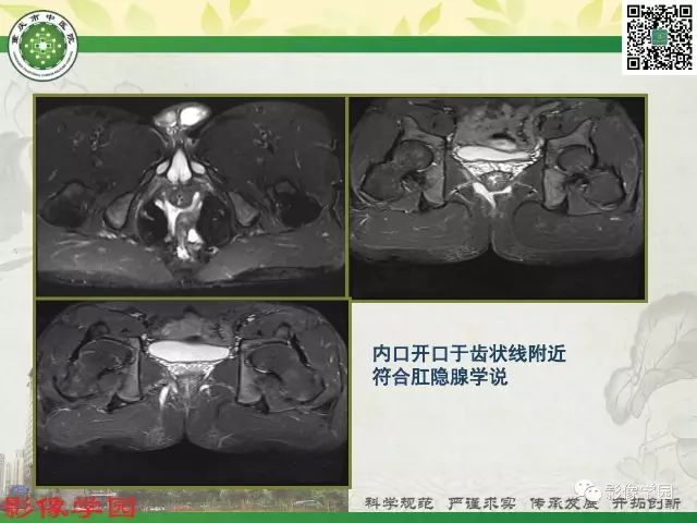 【PPT】复杂性肛瘘的MRI诊断