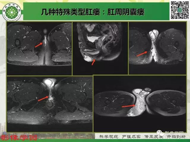 【PPT】复杂性肛瘘的MRI诊断