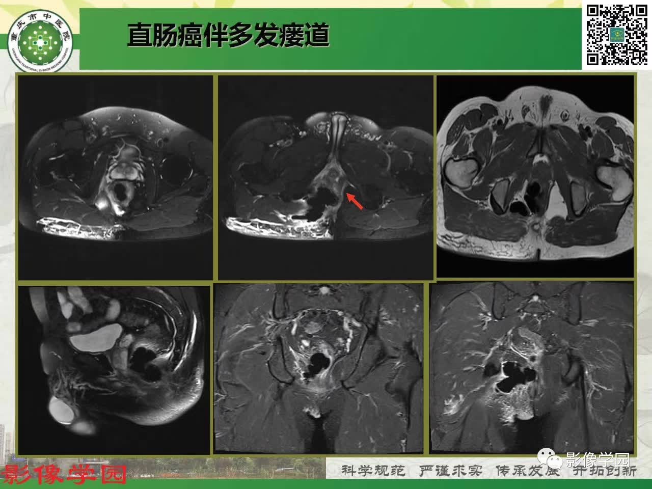 【PPT】复杂性肛瘘的MRI诊断