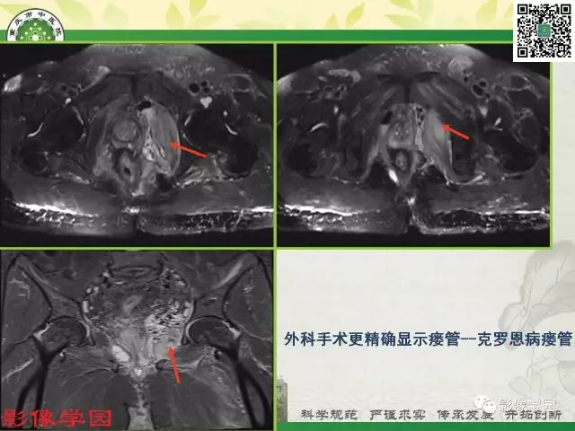 【PPT】复杂性肛瘘的MRI诊断