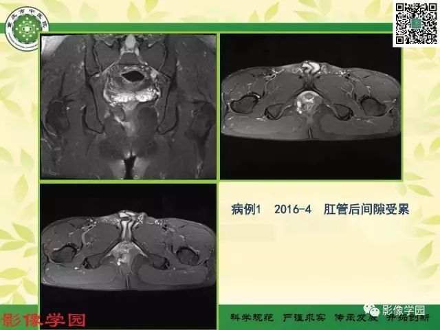 【PPT】复杂性肛瘘的MRI诊断