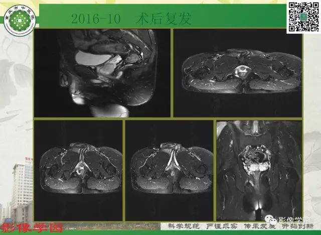 【PPT】复杂性肛瘘的MRI诊断