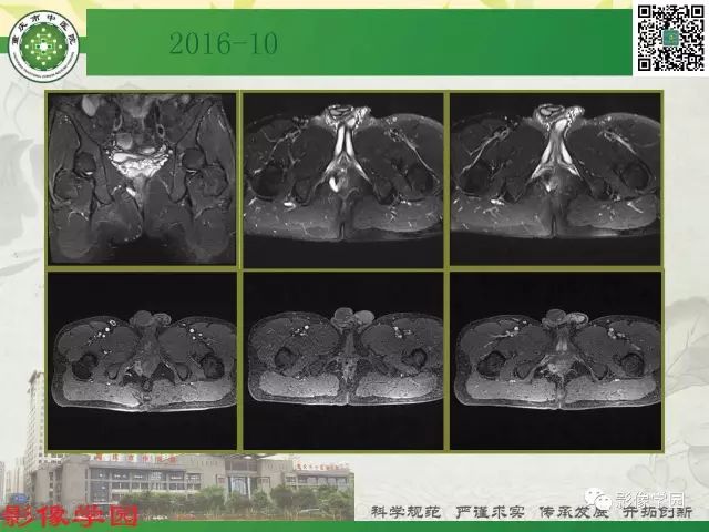 【PPT】复杂性肛瘘的MRI诊断