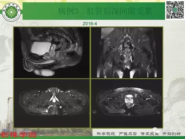 【PPT】复杂性肛瘘的MRI诊断