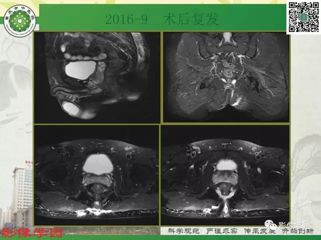 【PPT】复杂性肛瘘的MRI诊断