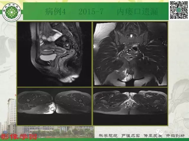 【PPT】复杂性肛瘘的MRI诊断