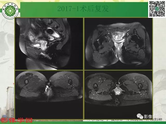 【PPT】复杂性肛瘘的MRI诊断
