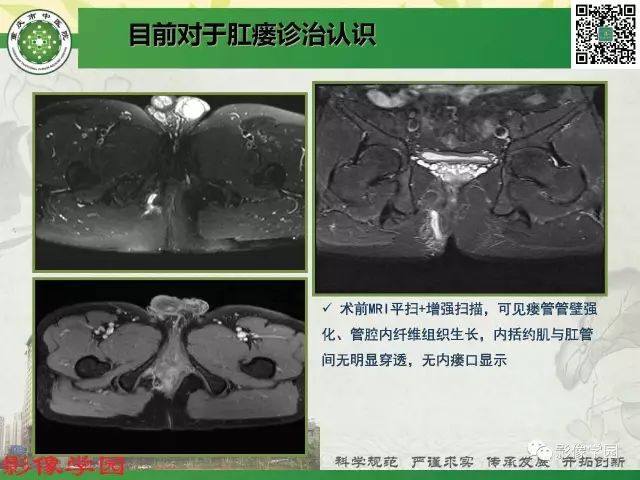 【PPT】复杂性肛瘘的MRI诊断