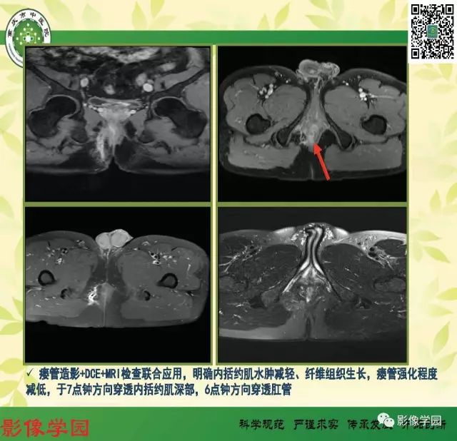 【PPT】复杂性肛瘘的MRI诊断