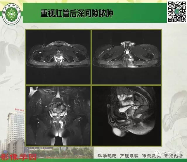 【PPT】复杂性肛瘘的MRI诊断