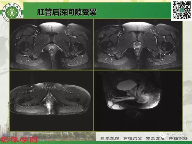 【PPT】复杂性肛瘘的MRI诊断