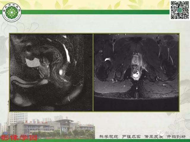 【PPT】复杂性肛瘘的MRI诊断