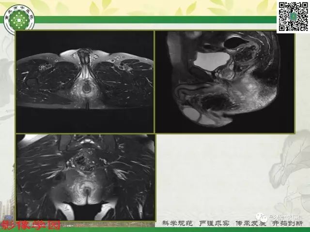 【PPT】复杂性肛瘘的MRI诊断