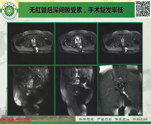 【PPT】复杂性肛瘘的MRI诊断