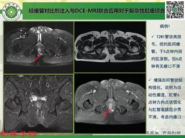 【PPT】复杂性肛瘘的MRI诊断