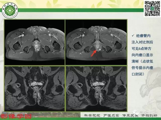 【PPT】复杂性肛瘘的MRI诊断
