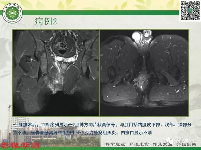 【PPT】复杂性肛瘘的MRI诊断