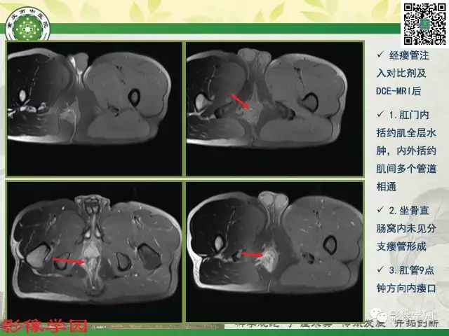 【PPT】复杂性肛瘘的MRI诊断