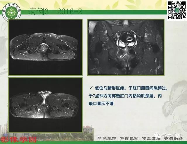 【PPT】复杂性肛瘘的MRI诊断