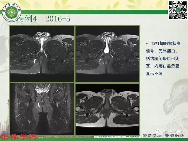 【PPT】复杂性肛瘘的MRI诊断