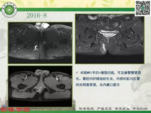 【PPT】复杂性肛瘘的MRI诊断