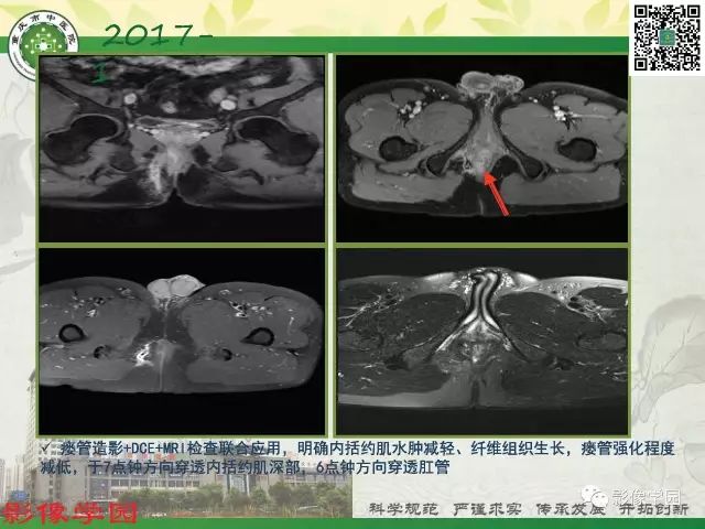 【PPT】复杂性肛瘘的MRI诊断