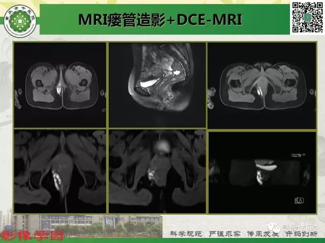 【PPT】复杂性肛瘘的MRI诊断