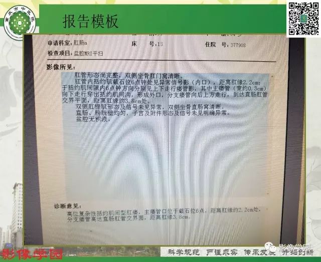 【PPT】复杂性肛瘘的MRI诊断