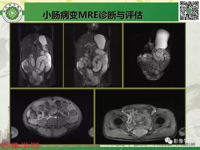 【PPT】复杂性肛瘘的MRI诊断