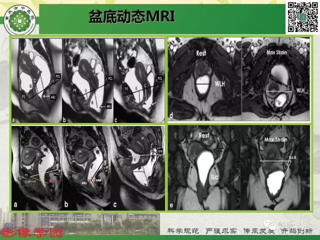 【PPT】复杂性肛瘘的MRI诊断