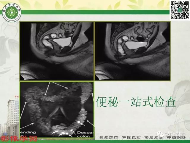 【PPT】复杂性肛瘘的MRI诊断