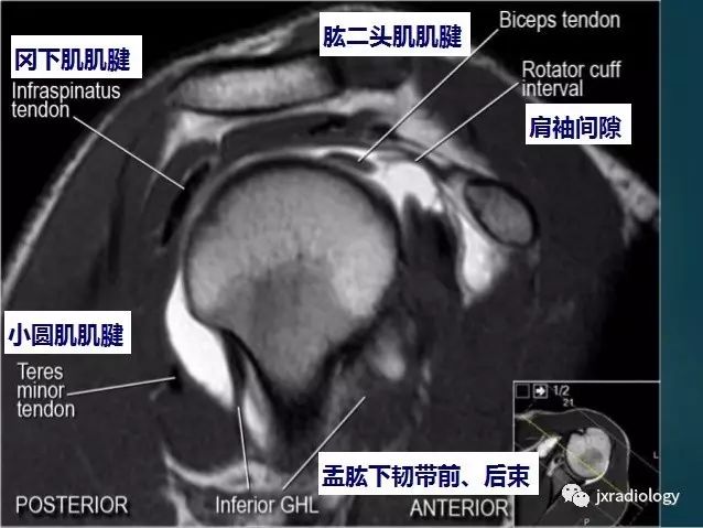 肩袖间隙的影像解剖及常见疾病
