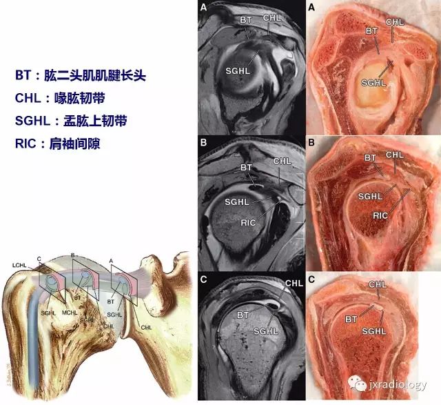 肩袖间隙的影像解剖及常见疾病 肩袖间隙的影像解剖及常见疾病