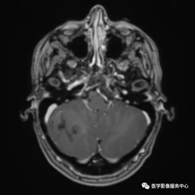 【病例】小脑发育不良性神经节细胞瘤1例MR影像表现