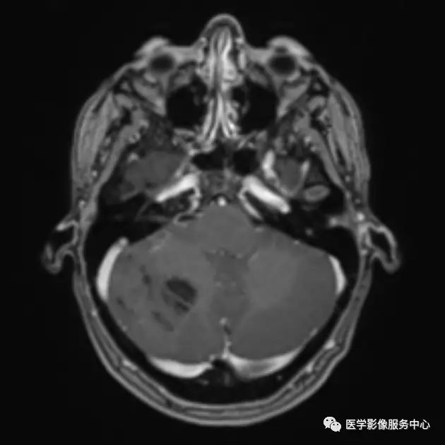 【病例】小脑发育不良性神经节细胞瘤1例MR影像表现